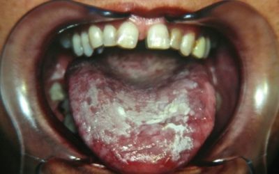 10-patologia-de-la-mucosa-oral-xl