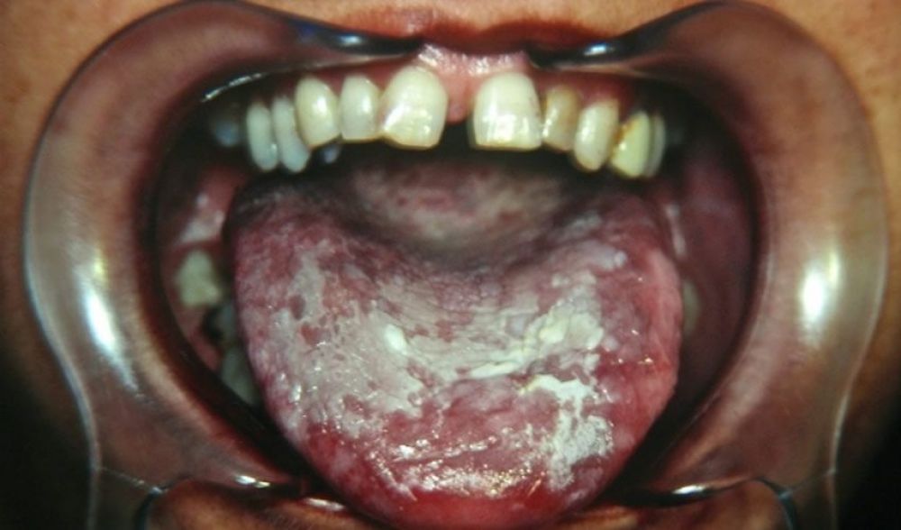 10-patologia-de-la-mucosa-oral-xl