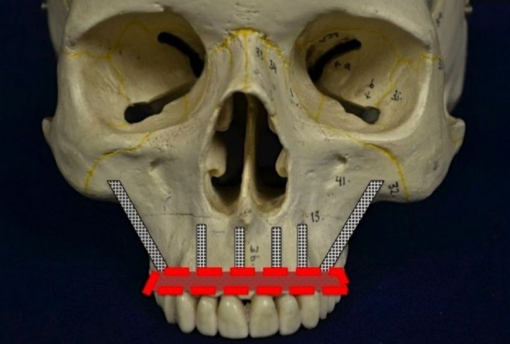 Implantes cigomáticos y pterigoideos