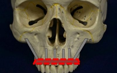 28-implantes-cigomaticos-xl-1