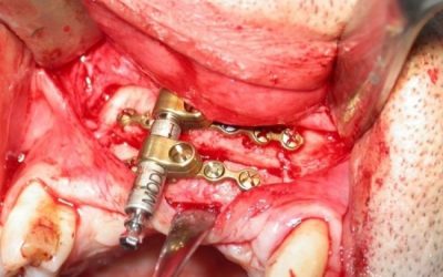 29-distraccion-osea-xl