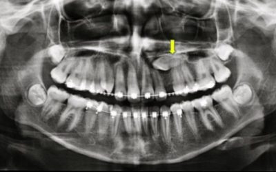 que-actitud-tomar-ante-un-canino-incluido