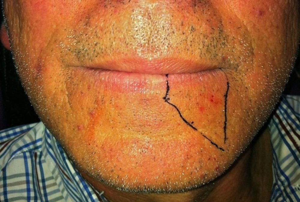 ¿Es cierto que se puede perder sensibilidad del labio tras la extracción de una muela del juicio inferior?