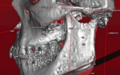 45-que-es-la-cirugia-ortognatica-xl