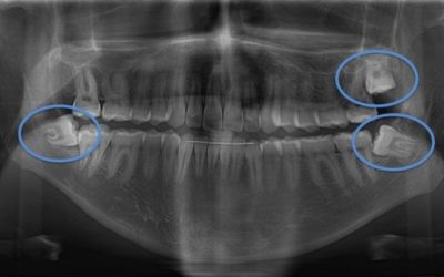 5-cordales-o-muelas-del-juicio-xl