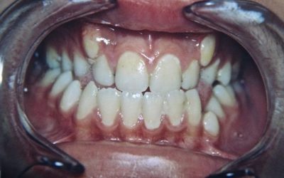 6-otras-inclusiones-dentarias-xl