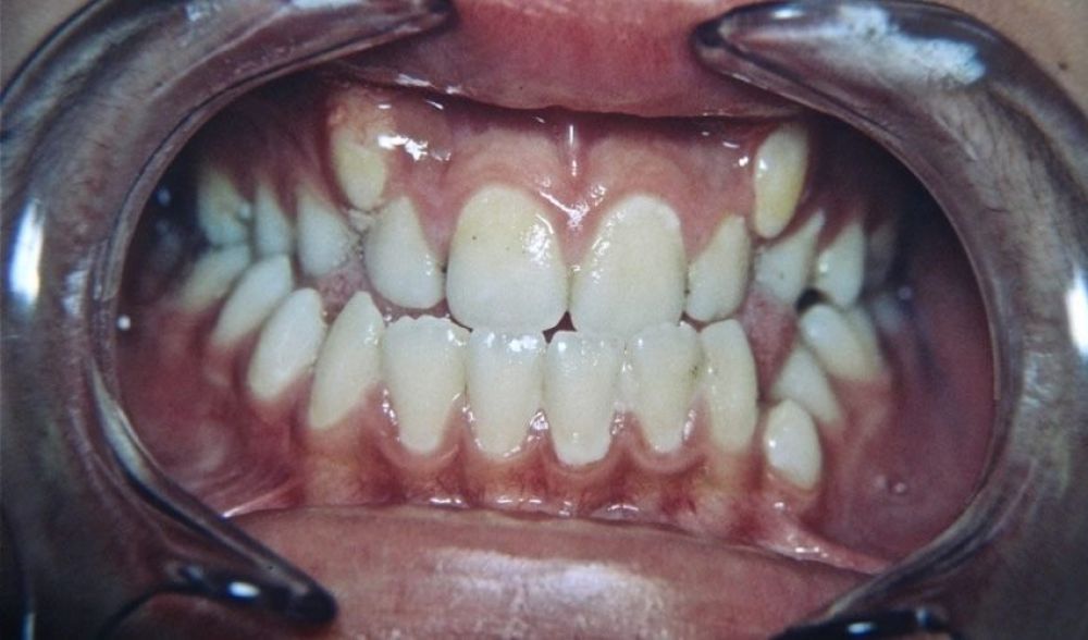 6-otras-inclusiones-dentarias-xl