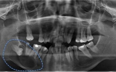 7-quistes-y-tumores-benignos-maxilares-xl