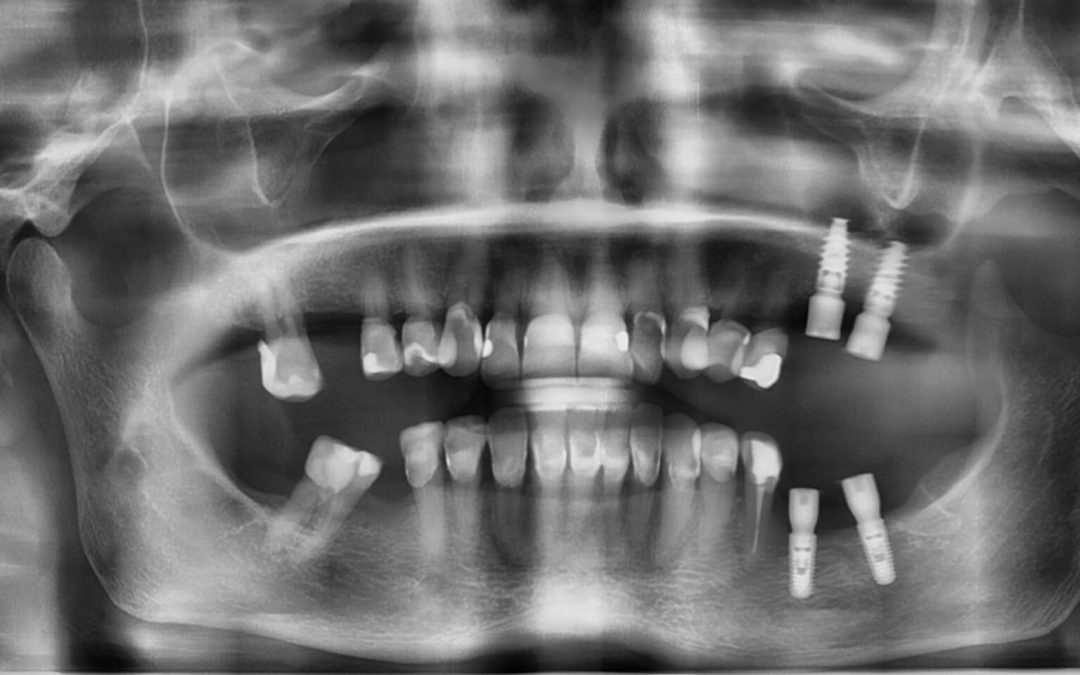 ¿Existe el rechazo de los implantes dentales?