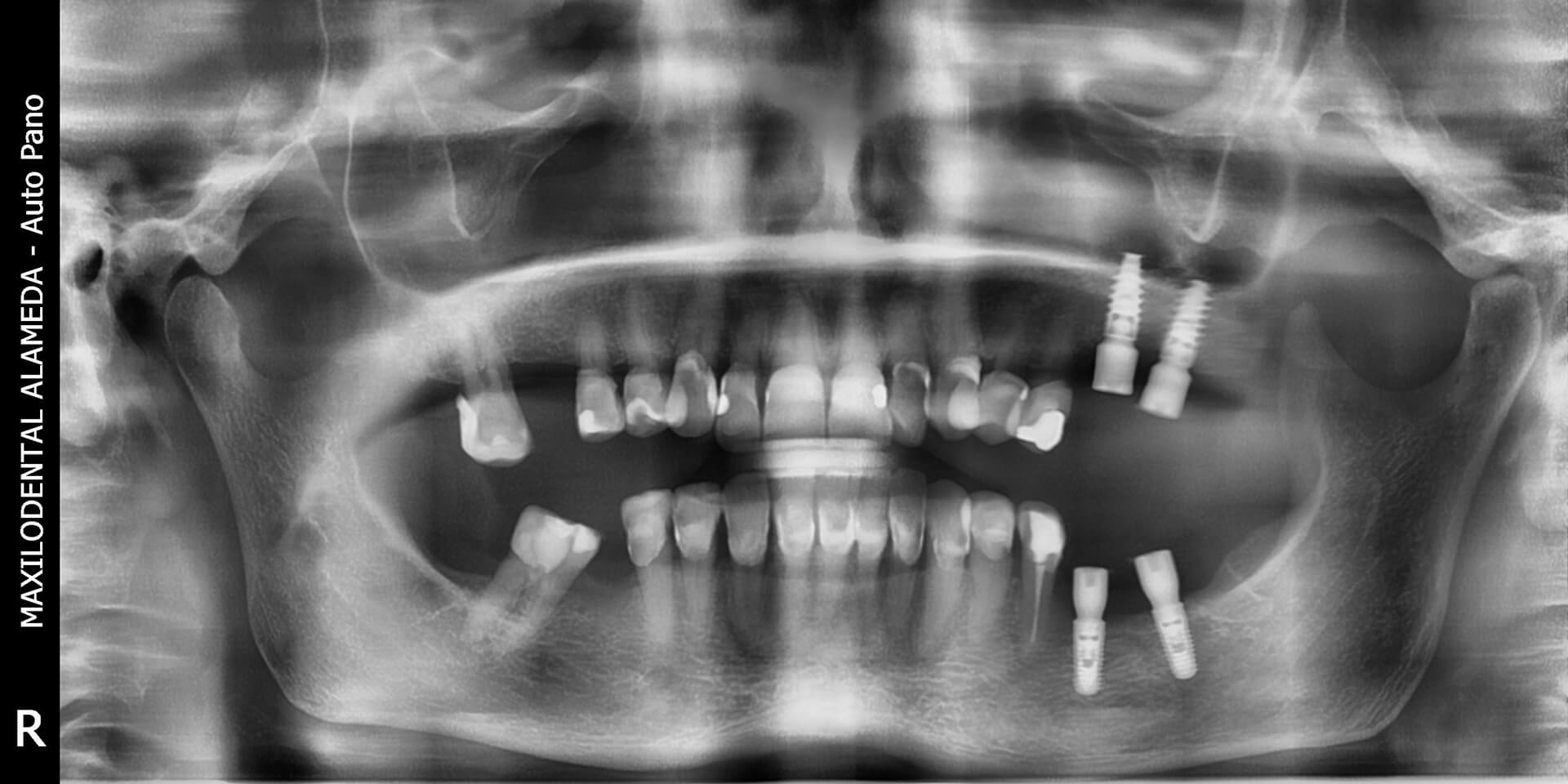 Existe-el-rechazo-de-los-implantes-dentales