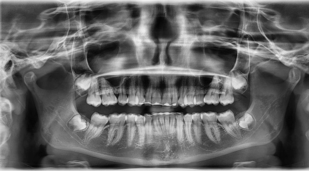 ¿Cuánto cuesta una extracción de muelas del juicio?