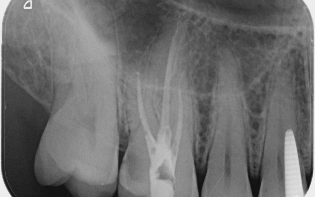 Endodoncia