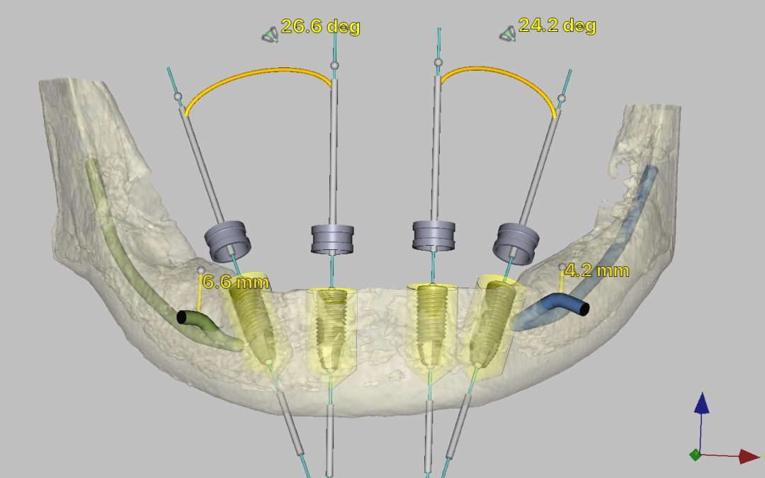 ¿Es necesario hacer un TAC para colocar implantes?